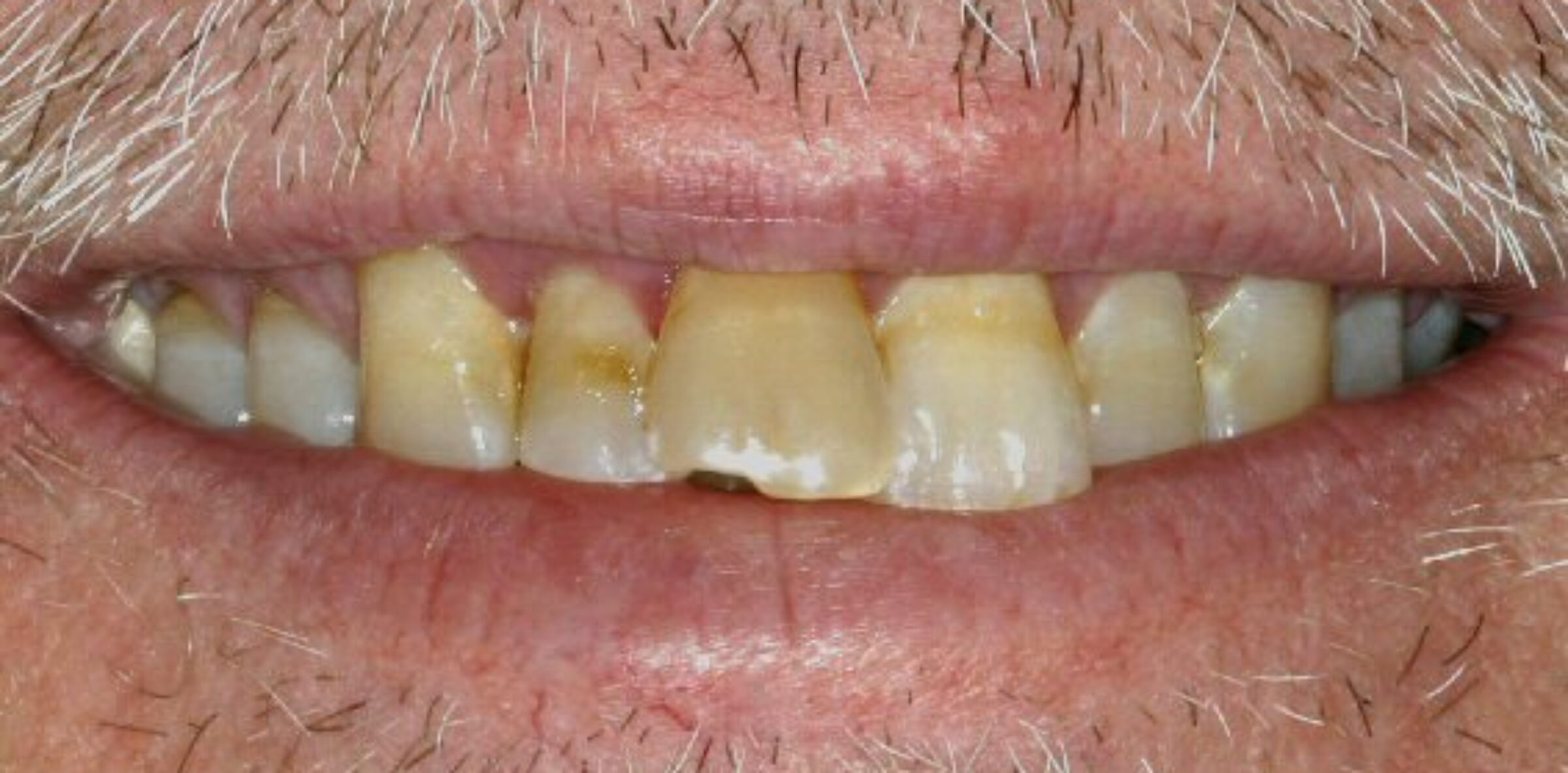 blog inner thumb :Absolute dental new Dental