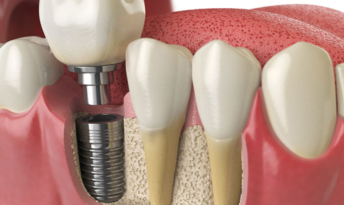 Blog - Absolute Dental