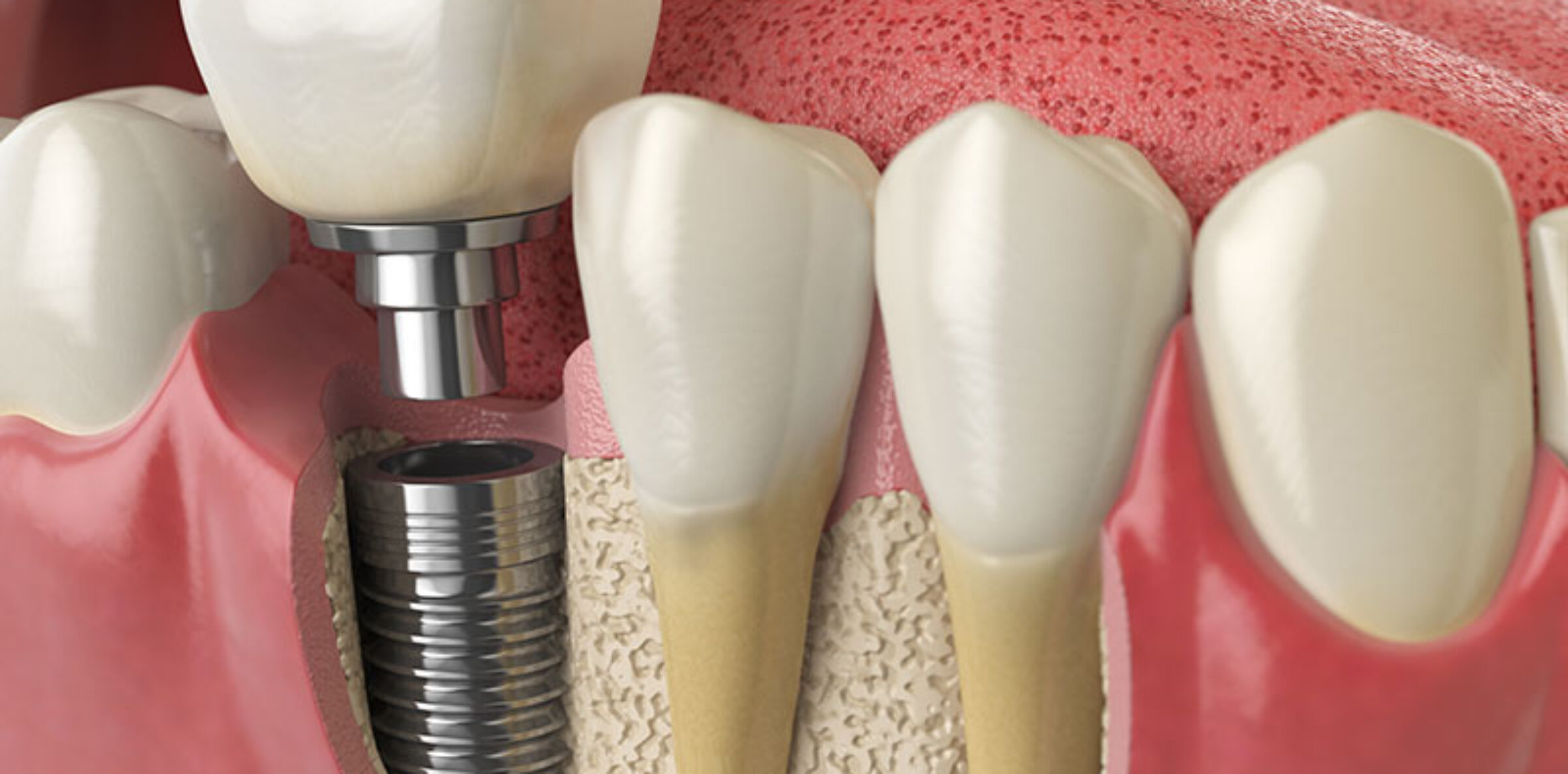 dental-implants-south-wales blog inner thumb : Absolute Dental